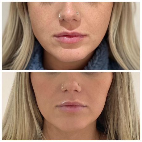 Anti-wrinkle injections for teeth grinding and jawline slimming