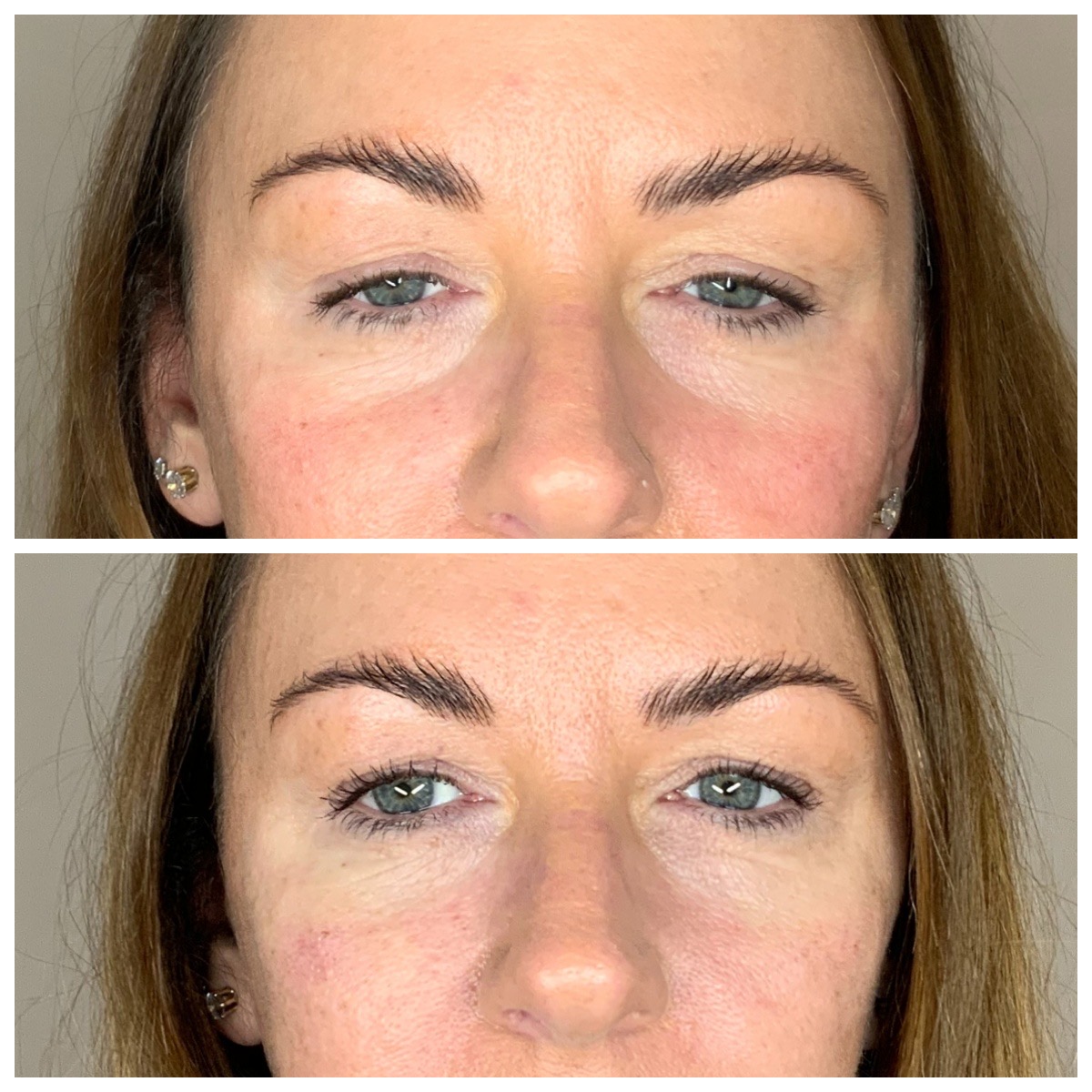 Eye bags treatment with dermal tear trough fillers at SF aesthetics