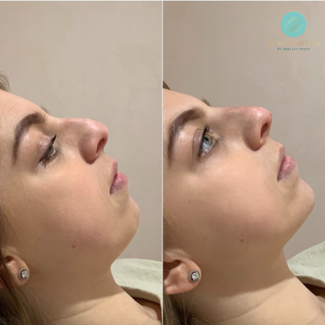 Non-Surgical Rhinoplasty at SF Aesthetics Wigan