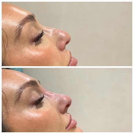 Non-Surgical Rhinoplasty at SF Aesthetics