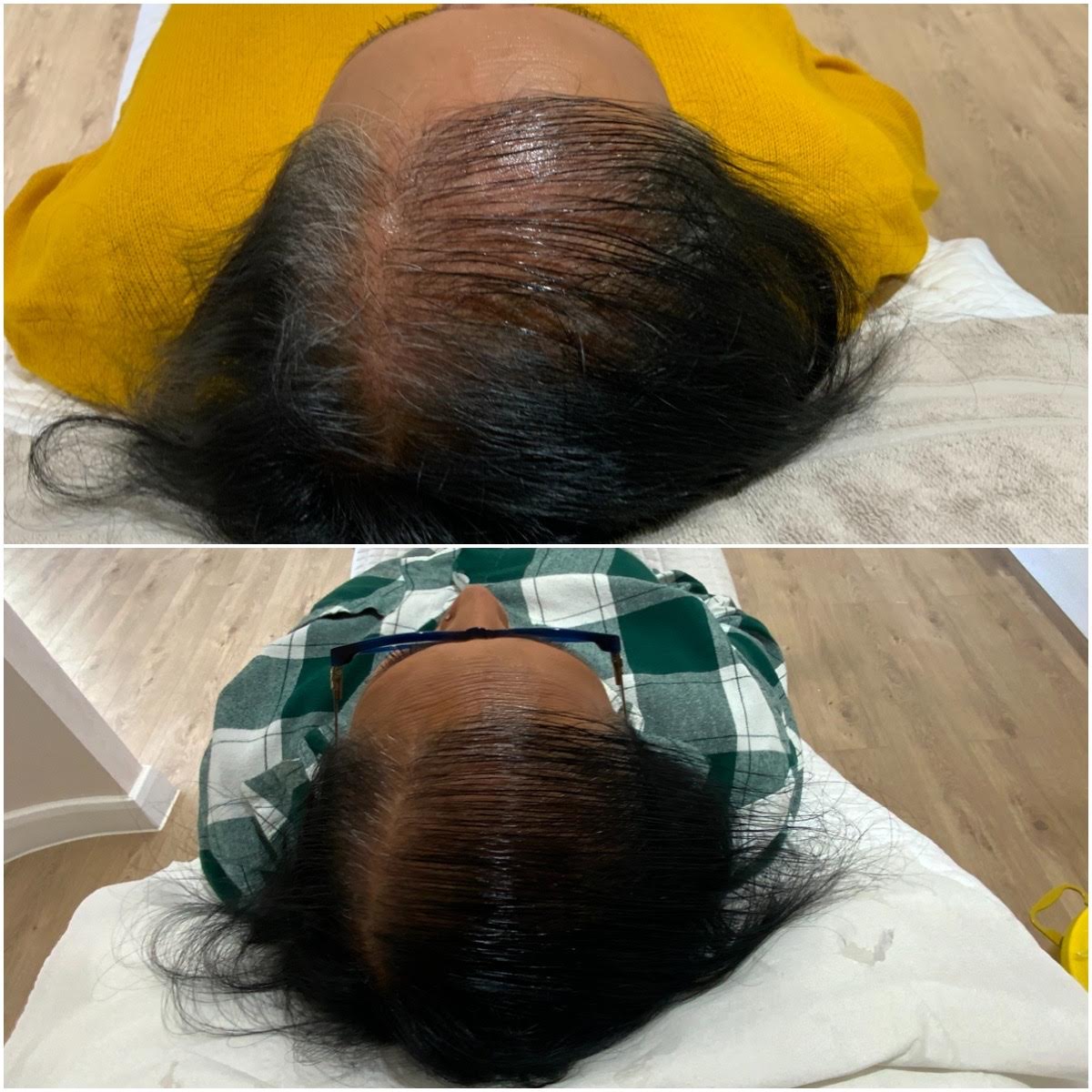 Platelet-Rich Plasma therapy PRP Before and after