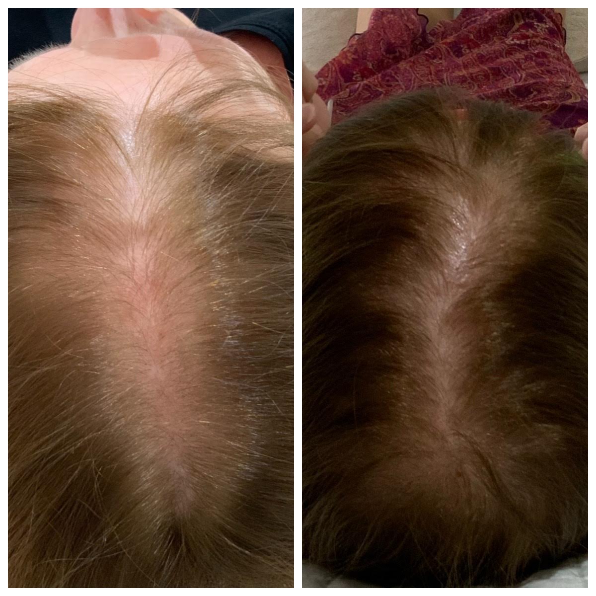 Platelet-Rich Plasma therapy PRP Therapy Before and after