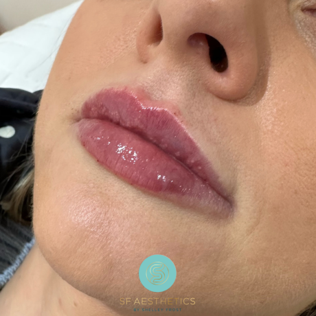 Lip augmentation with dermal fillers at SF Aesthetics Wigan