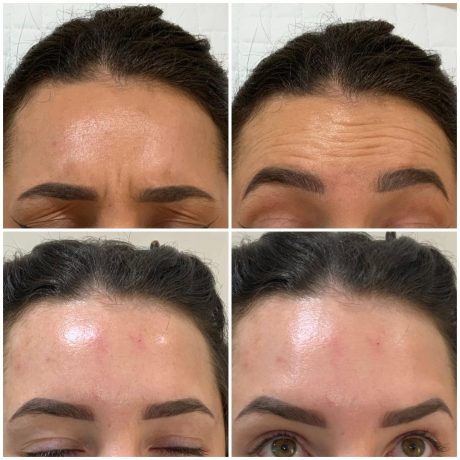 Before and after pictures of anti-wrinkle injections at SF Aesthetics Wigan