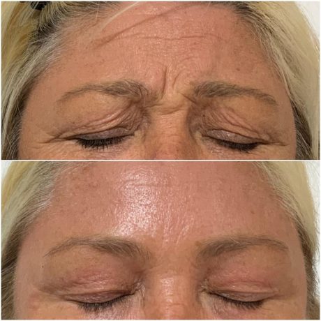 Anti wrinkle injections or Botox Wigan Anti-wrinkle injections here at SF Aesthetics Wigan before and after image of forehead and frown line treatment.