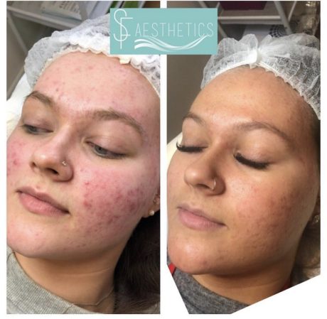 Acne Treatment with AlumierMD Skin care products