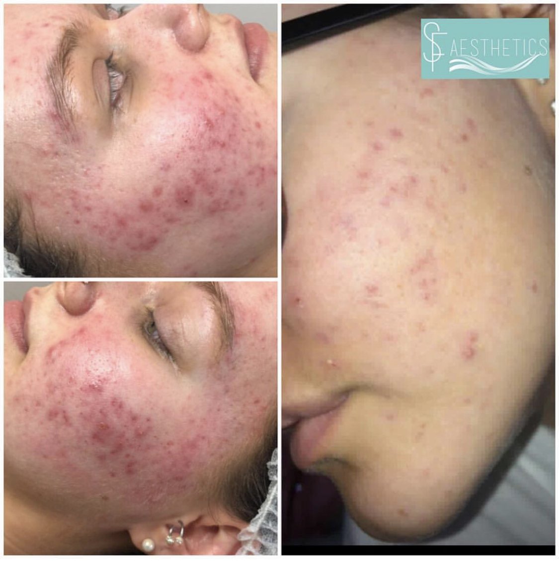 Acne Treatment with AlumierMD skin range