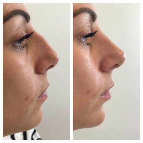 Dermal Fillers to rejuvenate face with profile balancing - SF Aesthetics