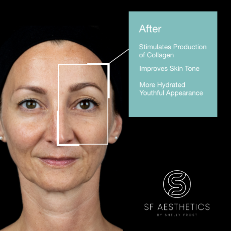 Polynucleotide Under Eyes Treatment